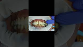 40 micron clearance and 80 micron resistance test for bilateral first molar implant crown GCam [upl. by Johst478]