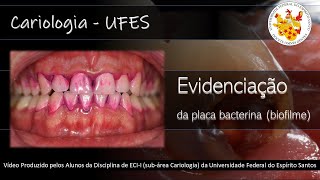 Para que o Dentista faz a EVIDENCIAÇÃO de placa bacteriana biofilme Veja a Técnica PassoaPasso [upl. by Ahsenod126]