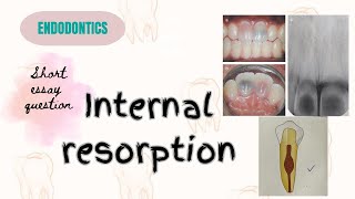 Internal resorptionEndodonticsshort essaywith easy notesimportantquestions easy dentalstudies [upl. by Allenod]