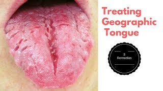 Top 5 Home Remedies for Treating Geographic Tongue [upl. by Simaj628]