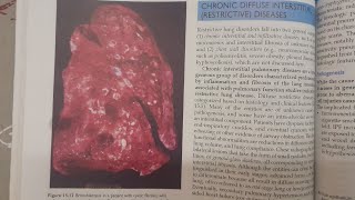 Bronchiectasis  SPECIAL PATHOLOGY [upl. by Caryn989]