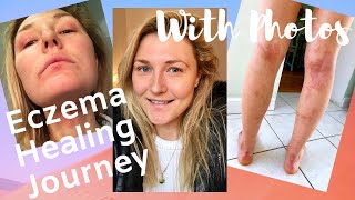 How I cured my Eczema Naturally  My Eczema Journey  Heal Eczema NATURALLY [upl. by Castera]