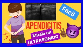 Apendicitis síntomas y ULTRASONIDO ✅ [upl. by Ondine]