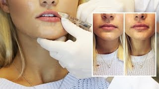 Lip Filler Experience  Start to Finish with 1 Syringe of Juvederm [upl. by Sitto]