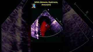 WMA Akinesia Dyskinesia Aneurysm [upl. by Ber]