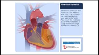 Ventricular Fibrillation Animation Video [upl. by Vivyanne]