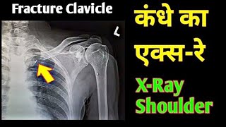 Fracture Clavicle Medial End  Broken Collar bone  XRay Shoulder  UdayXray [upl. by Oag]