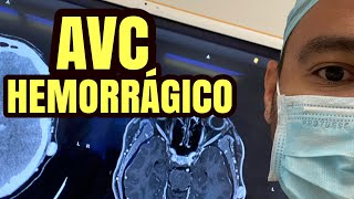 AVC hemorrágico qual o tratamento [upl. by Gavra]