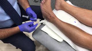 Ankle Steroid injection [upl. by Elie439]