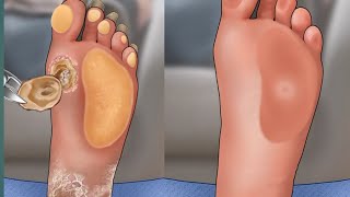 Foot Infection Treatment Animation ASMR ASMR skincare Animation Dead Foot Skin Removal [upl. by Hayashi]