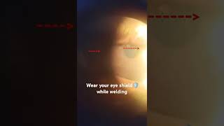 Welding Flesh  How To Take Care of Eye shots Swaineyeclinic welder eyepain reels explore [upl. by Oahc]