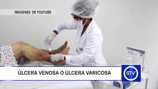 ÚLCERA VENOSA O ÚLCERA VARICOSA [upl. by Ynot823]