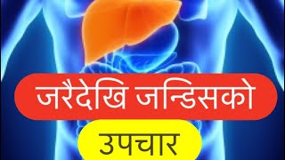 Jaundice in Nepali जन्डिस के हो कसरि उपचार गर्ने [upl. by Rustice]