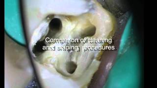 PeriodontalEndodontic considerations [upl. by Any717]