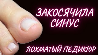 ПЕДИКЮР  ОБРАБОТКА ПАЛЬЦЕВ  лохматый синус [upl. by Lerat]