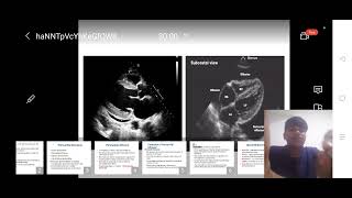 Pericardial disease Basic session 1 [upl. by Yttap]