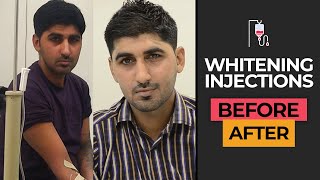 BeforeAfter Full Body Whitening Transformation in Karachi Pakistan  Glutathione Injection Results [upl. by Eyssej]