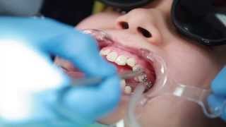 Braces Putting Braces On Bonding Procedure  Aura Orthodontics [upl. by Ytissahc]