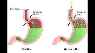 Acid Reflux Treatment  Acid Reflux Symptoms Acid Reflux Homeopathic Treatment Homeopathy Medicine [upl. by Goldy386]