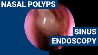 Nasal polyps  PHACON Sinus Patient Meyer [upl. by Winni]