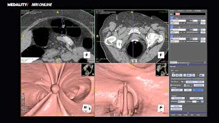 Screening CT Colonography Radiology Course Preview  Medality formerly MRI Online [upl. by Christine]