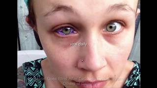 Model Goes Blind After Tattooing Eyeball Warns Others of Dangers [upl. by Ynotna]