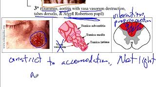 USMLE ACE Video 91 Genital Ulcers [upl. by Reinaldos]