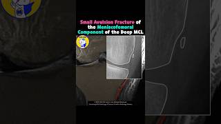 Fig 3A22 Avulsion fracture of meniscofemoral ligament [upl. by Aerdnahs]