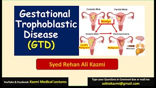 Gestational Trophoblastic Disease  Molar pregnancy  Obstetric review  KML [upl. by Ellierim]