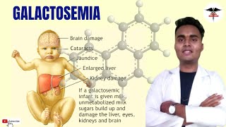 WHAT IS GALACTOSEMIA   CLINICAL ASPECTS  DIAGNOSIS  ENZYME DEFICIENT  TREATMENT [upl. by Ujawernalo]