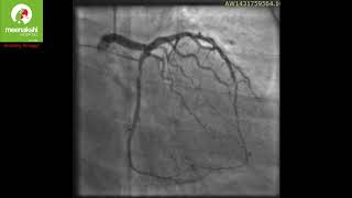 Spontaneous Dissection of Coronary Arteries A Rarity [upl. by Nosnirb]