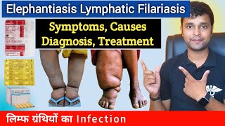 Elephantiasis  Filariasis  Symptoms Causes Diagnosis Treatment Prevention In Hindi [upl. by Lambertson]