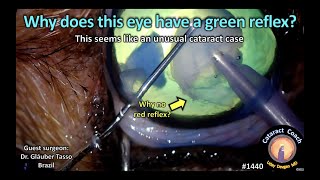 CataractCoach 1440 green reflex in canine cataract surgery [upl. by Ydollem]