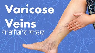 Varicose Veins ꯚꯦꯔꯤꯀꯣꯖ ꯚꯦꯏꯟ [upl. by Ynagoham807]