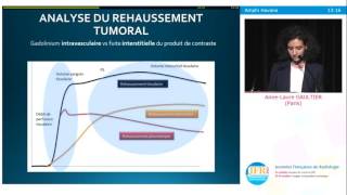 IRM de perfusion des tumeurs de loropharynx différenciation p16 p16 en imagerie fonctionnelle [upl. by Eyeleen372]