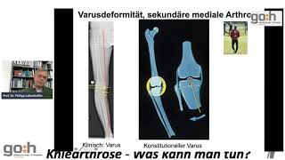 3 Welche gelenkerhaltende Operationsmethoden gibt es ASK Knorpeltherapie Umstellungsosteotomie [upl. by Aisel221]