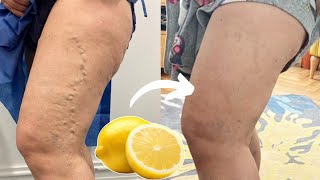 Lemon Removes Varicose Veins This Is What You Need To Do [upl. by Annoet]