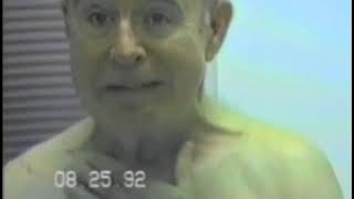 310 Orofacial Dystonia with Lower facial and Platysma Dystonia  Dystonias Spring Video Atlas [upl. by Frendel]