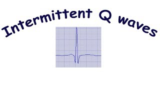 Intermittent pathological Qwaves [upl. by Laehplar]