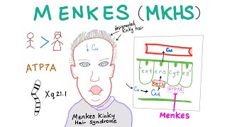 Menkes Disease  Menkes Kinky Hair Syndrome  Copper [upl. by Edak]