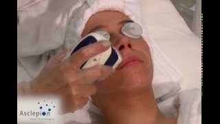 MeDioStar NeXT  Training video for hair removal face from Asclepion [upl. by Simetra]