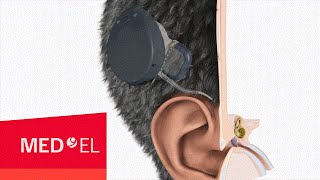 The RONDO cochlear implant from MEDEL  2D  INT [upl. by Brackett]