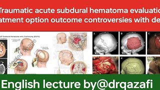 Traumatic acute subdural hematomaEnglish lecture evaluation treatment option outcome controversies [upl. by Eemiaj]