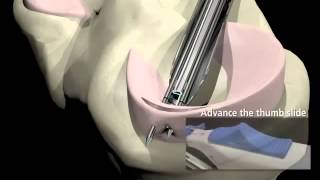 Arthroscopic Meniscus Repair [upl. by Eugen]