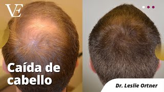 CÓMO DETENER LA CAIDA DE CABELLO  Tratamiento para tener un pelo sano y fuerte [upl. by Anairt]