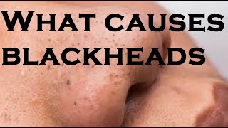 What causes blackheads [upl. by Aubine419]