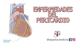 Pericarditis aguda Derrame pericárdico Taponamiento cardiaco y Pericarditis constrictiva [upl. by Arimlede]