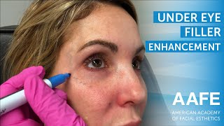 Under Eye Filler Enhancement [upl. by Ahsiner]