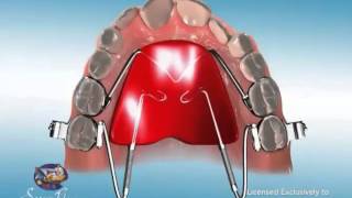 ES Ortho and Distal Jet Appliance [upl. by Laura]