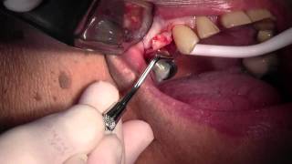 CAMLOG Implant Placement 5 Site Flap Design amp Pilot Hole [upl. by Whelan456]